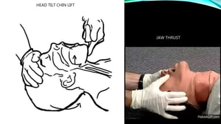 HEAD TILT CHIN LIFT
JAW THRUST
 