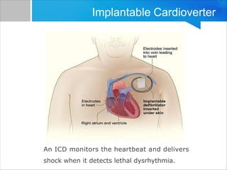 An ICD monitors the heartbeat and delivers
shock when it detects lethal dysrhythmia.
Implantable Cardioverter
 
