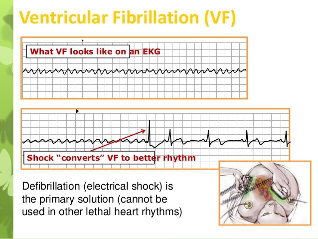 Cardiac arrest