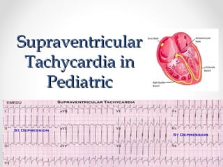 SupraventricularSupraventricular
Tachycardia inTachycardia in
PediatricPediatric
 