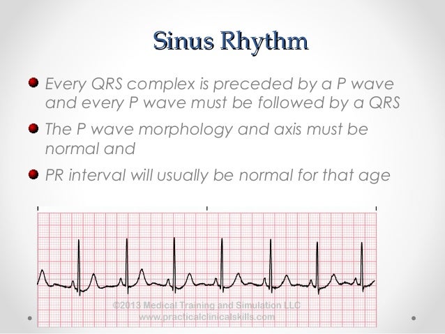 What Is Svt >> Svt In Pediatrics What Is Svt >> Svt In Pediatrics
