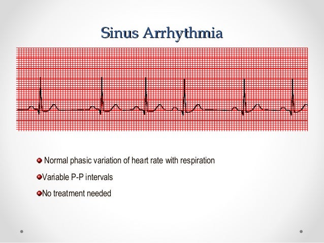 SVT in pediatrics