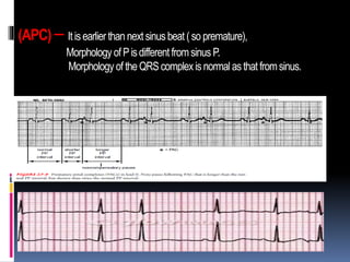 (APC) – Itisearlierthannextsinusbeat (sopremature),
MorphologyofPisdifferentfromsinusP.
MorphologyoftheQRScomplexisnormalasthat fromsinus.
 