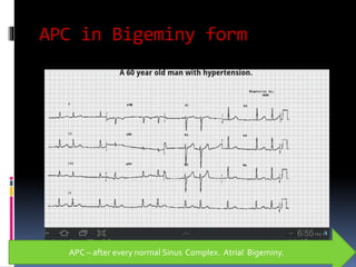 APC in Bigeminy form
APC – after every normal Sinus Complex. Atrial Bigeminy.
 