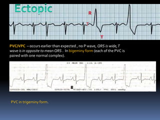PVC/VPC – occurs earlier than expected , no P wave, QRS is wide,T
wave is in opposite to mean QRS . In bigeminy form (each of the PVC is
paired with one normal complex).
PVC in trigeminy form.
 