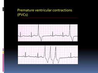 Premature ventricular contractions
(PVCs)
 