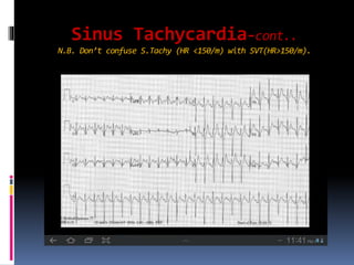 Sinus Tachycardia-cont..
N.B. Don’t confuse S.Tachy (HR <150/m) with SVT(HR>150/m).
 