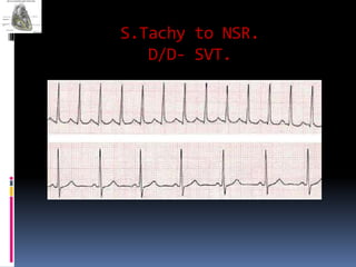 S.Tachy to NSR.
D/D- SVT.
 
