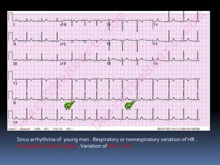 Sinus arrhythmia of young man . Respiratory or nonrespiratory variation of HR .
In inspiration rate is higher .Variation of HR > 10 % .
 
