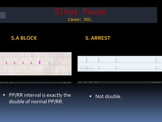 Sinus Pause
Cause: SSS.
S.A BLOCK S. ARREST
 PP/RR interval is exactly the
double of normal PP/RR.
 Not double.
 