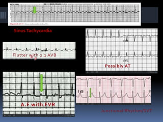 SinusTachycardia
Junnctional Rhythm
 