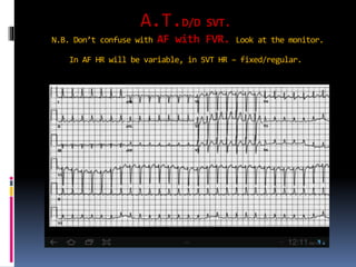 A.T.D/D SVT.
N.B. Don’t confuse with AF with FVR. Look at the monitor.
In AF HR will be variable, in SVT HR – fixed/regular.
 