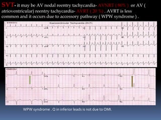 SVT- it may be AV nodal reentry tachycardia- AVNRT ( 80% ) or AV (
atrioventricular) reentry tachycardia- AVRT ( 20 %) . AVRT is less
common and it occurs due to accessory pathway ( WPW syndrome ) .
WPW syndrome . Q in inferior leads is not due to OMI.
 