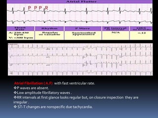 Atrial Fibrillation ( A.F) with fast ventricular rate.
P waves are absent.
Low amplitude fibrillatory waves .
RR intervals at first glance looks regular but, on closure inspection they are
irregular .
 ST-T changes are nonspecific due tachycardia.
 