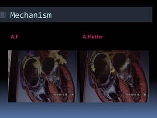 Mechanism
A.F A.Flutter
 