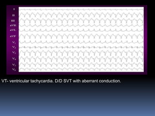 VT- ventricular tachycardia. D/D SVT with aberrant conduction.
 