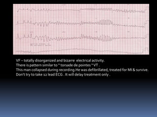 VF – totally disorganized and bizarre electrical activity.
There is pattern similar to “ torsade de pointes “VT .
This man collapsed during recording.He was defibrillated, treated for MI & survive.
Don’t try to take 12 lead ECG . It will delay treatment only .
 