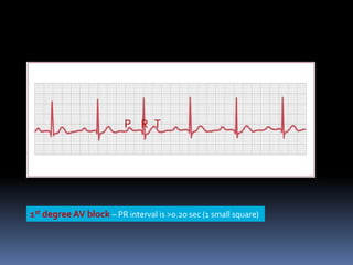 1st degree AV block – PR interval is >0.20 sec (1 small square)
 