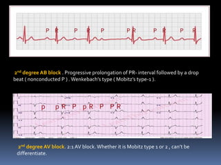 2nd degree AB block . Progressive prolongation of PR- interval followed by a drop
beat ( nonconducted P ) . Wenkebach’s type ( Mobitz’s type-1 ).
2nd degree AV block. 2:1 AV block.Whether it is Mobitz type 1 or 2 , can’t be
differentiate.
 