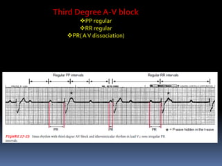 Third Degree A-V block
PP regular
RR regular
PR( AV dissociation)
 