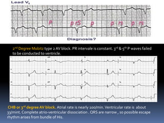 2nd Degree Mobitz type 2 AV block. PR intervale is constant. 3rd & 5th P waves failed
to be conducted to ventricle.
CHB or 3rd degree AV block. Atrial rate is nearly 100/min.Ventricular rate is about
33/mint. Complete atrio-ventricular dissociation . QRS are narrow , so possible escape
rhythm arises from bundle of His.
 