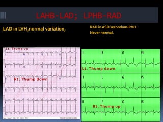 LAHB-LAD; LPHB-RAD
LAD in LVH,normal variation, RAD in ASD secondum-RVH.
Never normal.
Lt. Thump down
Rt. Thump down
Rt. Thump up
 