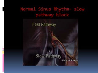 Normal Sinus Rhythm- slow
pathway block
 