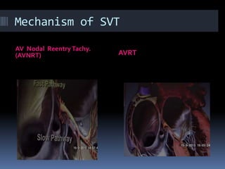 Mechanism of SVT
AV Nodal ReentryTachy.
(AVNRT) AVRT
 
