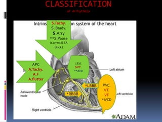 CLASSIFICATION
of Arrhythmia
S.Tachy.
S. Brady.
S.Arry
**S.Pause
(s.arrest & SA
block)
APC
A.Tachy.
A.F
A.flutter
J.Ect
SVT.
**AVB
PVC.
VT.
VF
*IVCD
*RBBB
*LBBB
 
