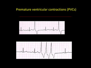 Pcvs Cardiac arrhythmia | PPTX