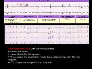 Cardiac arrhythmia | PPTX