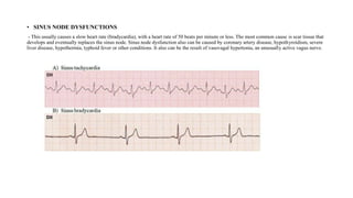 • SINUS NODE DYSFUNCTIONS
- This usually causes a slow heart rate (bradycardia), with a heart rate of 50 beats per minute or less. The most common cause is scar tissue that
develops and eventually replaces the sinus node. Sinus node dysfunction also can be caused by coronary artery disease, hypothyroidism, severe
liver disease, hypothermia, typhoid fever or other conditions. It also can be the result of vasovagal hypertonia, an unusually active vagus nerve.
 