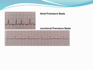Atrial Premature Beats
Junctional Premature Beats
 