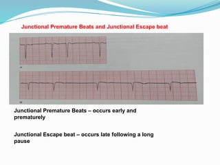 Junctional Premature Beats and Junctional Escape beat
Junctional Premature Beats – occurs early and
prematurely
Junctional Escape beat – occurs late following a long
pause
 