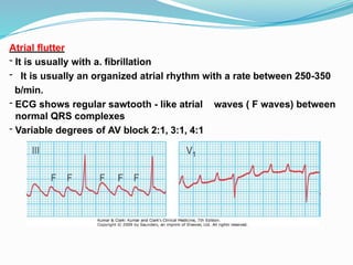 Atrial flutter
- It is usually with a. fibrillation
- It is usually an organized atrial rhythm with a rate between 250-350
b/min.
- ECG shows regular sawtooth - like atrial waves ( F waves) between
normal QRS complexes
- Variable degrees of AV block 2:1, 3:1, 4:1
 