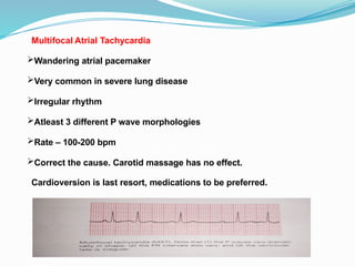 Multifocal Atrial Tachycardia
Wandering atrial pacemaker
Very common in severe lung disease
Irregular rhythm
Atleast 3 different P wave morphologies
Rate – 100-200 bpm
Correct the cause. Carotid massage has no effect.
Cardioversion is last resort, medications to be preferred.
 