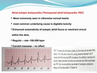 Atrial ectopic tachycardia ( Paroxysmal atrial tachycardia -PAT)
 Most commonly seen in otherwise normal hearts
 most common underlying cause is digitalis toxicity
Enhanced automaticity of ectopic atrial focus or reentrant circuit
within the atria.
Regular – rate -100-200 bpm
Carotid massage – no effect
 