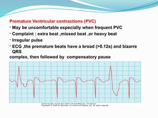 Premature Ventricular contractions (PVC)
- May be uncomfortable especially when frequent PVC
- Complaint : extra beat ,missed beat ,or heavy beat
- Irregular pulse
- ECG ,the premature beats have a broad (>0.12s) and bizarre
QRS
complex, then followed by compensatory pause
 