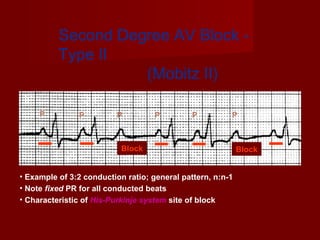 Mobitz Patterns Arrhythmia broad overview | PPT