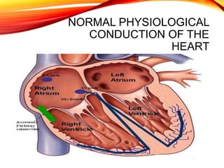 NORMAL PHYSIOLOGICAL
CONDUCTION OF THE
HEART
 