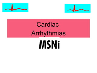 Cardiac  Arrhythmias 