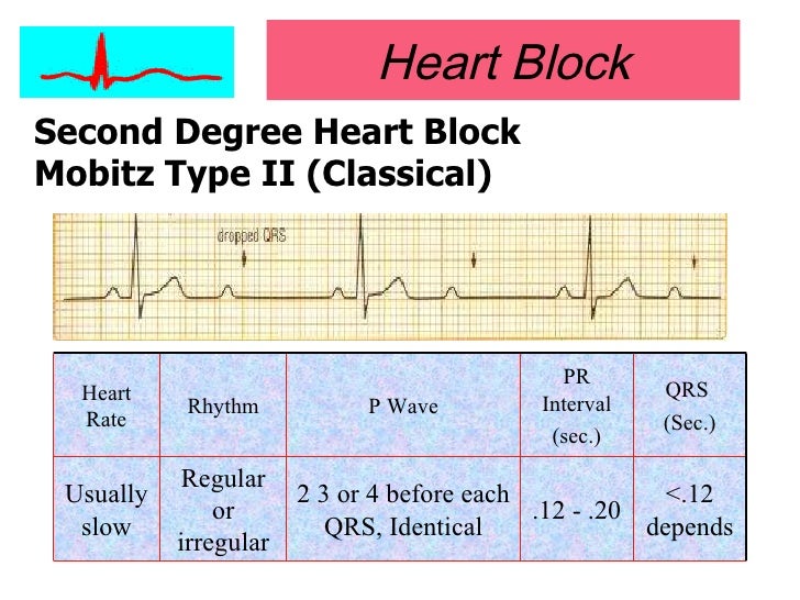 Second degree. Second degree. Mobitz type 1. Second degree av block type 2. Sinoatrial block.
