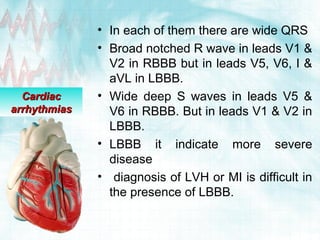Cardiac arrhythmias | PPT