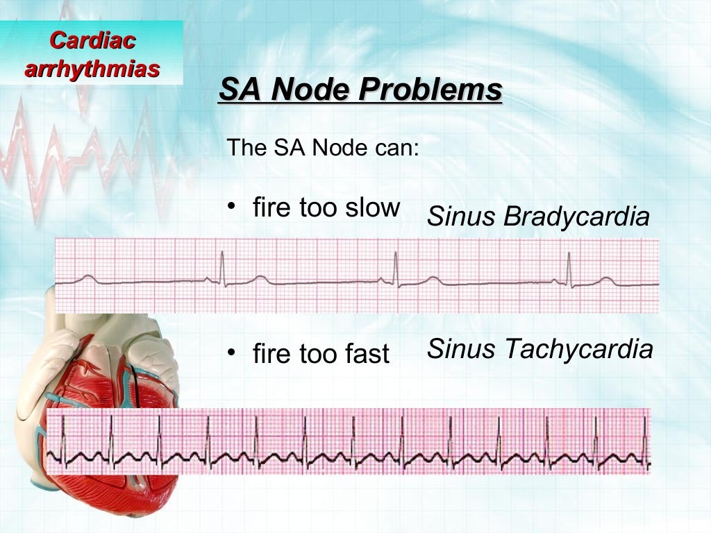 Cardiac arrhythmias