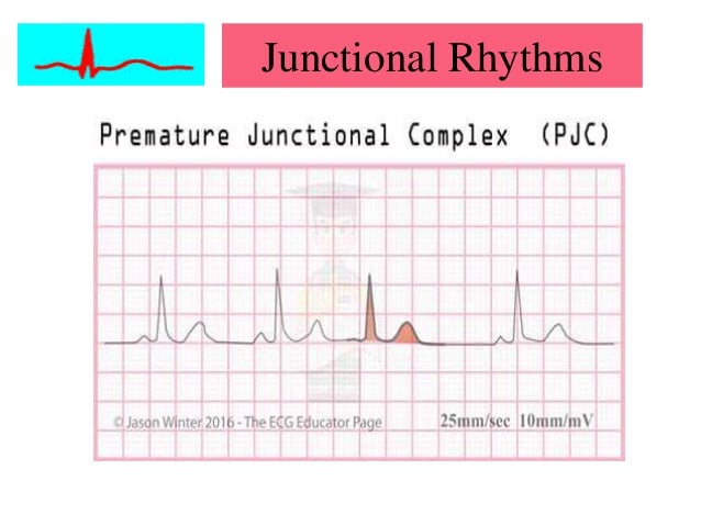 Cardiac Arrhythmias
