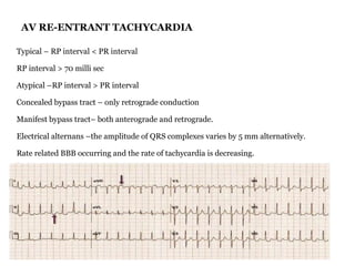 What Is Rp Interval Cardiac arrhythmias | PPT