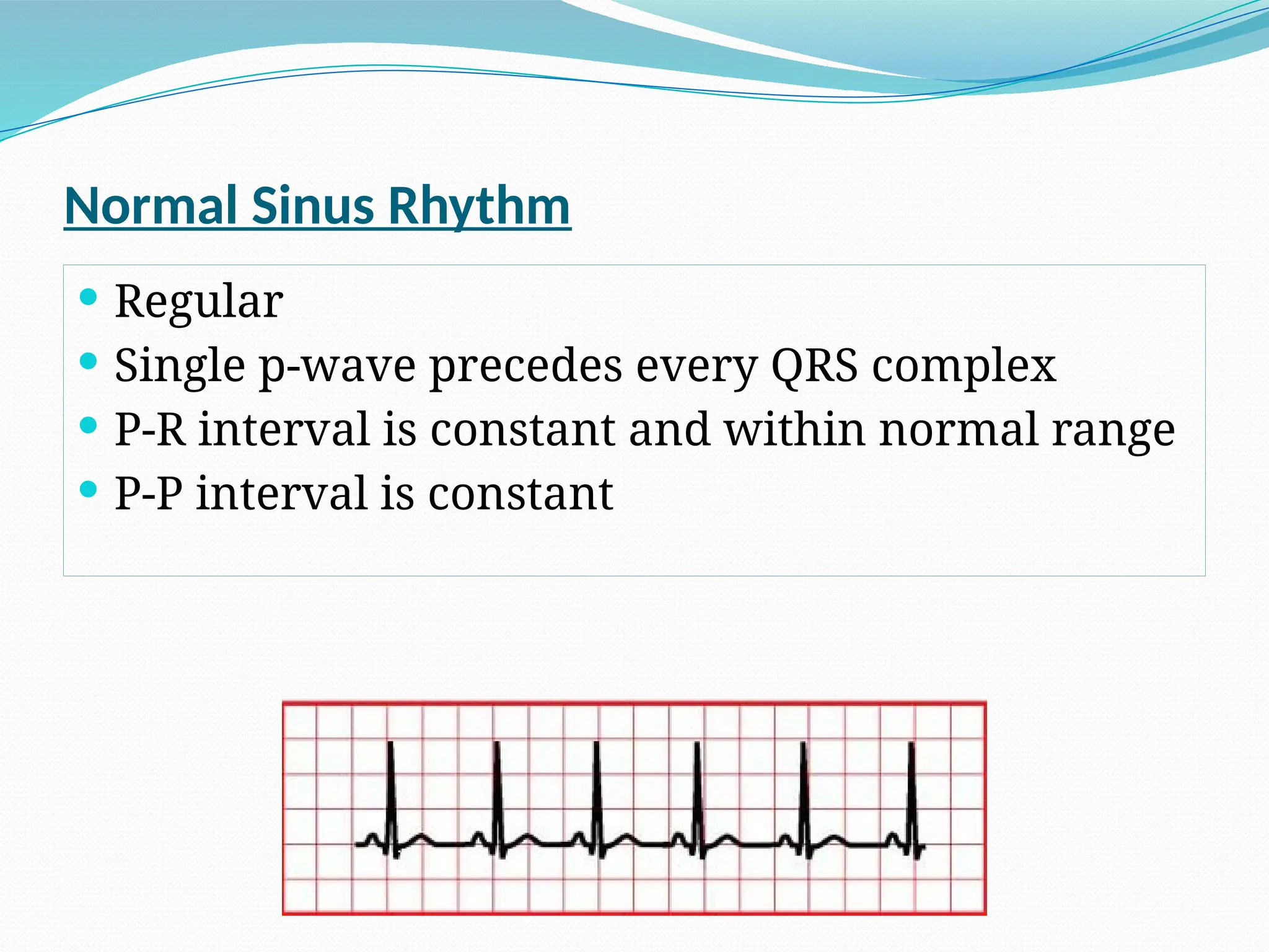 Cardiac Arrhythmias, Pathophysiology Lecture (Cardiology). pptx | PPTX