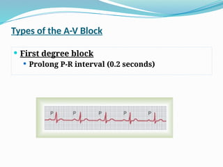 Cardiac Arrhythmias, Pathophysiology Lecture (Cardiology). pptx | PPTX
