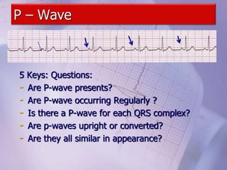 P – Wave
5 Keys: Questions:
- Are P-wave presents?
- Are P-wave occurring Regularly ?
- Is there a P-wave for each QRS complex?
- Are p-waves upright or converted?
- Are they all similar in appearance?
 