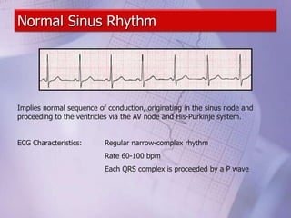 Normal Sinus Rhythm
Implies normal sequence of conduction, originating in the sinus node and
proceeding to the ventricles via the AV node and His-Purkinje system.
ECG Characteristics: Regular narrow-complex rhythm
Rate 60-100 bpm
Each QRS complex is proceeded by a P wave
 